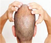 دواء لاستعادة الشعر بالكامل لدى المصابين بمرض مناعي يسبب الصلع
