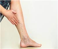 دراسة تحذر من علامة في ساقك قد تشير إلى الإصابة بالسرطان