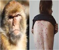 1600 إصابة مؤكدة بجدري القردة في 39 دولة حول العالم