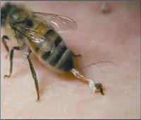 لسعة نحلة.. تخلص من التهيج المؤلم بهذه العلاجات المنزلية السهلة