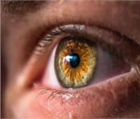 نصائح صحية.. أعراض «المهق العيني» وكيفية للتغلب عليه