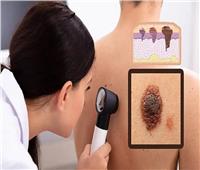  أعراض أنواع سرطان الجلد الحميد 