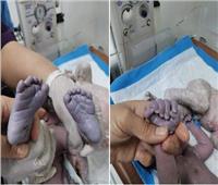 ولادة نادرة ..سيدة تضع مولودها بصحة جيدة وبـ24 إصبعاً !
