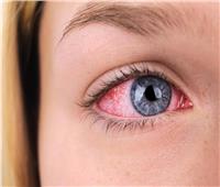 الحكة وجفاف العين.. أبرز تأثيرات استخدام التكييف لفترة طويلة