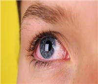 نصائح صحية.. ما علاج احمرار عين واحدة فجأة 
