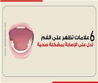 إنفوجراف| 6 علامات تظهر على الفم تدل على الإصابة بمشكلة صحية