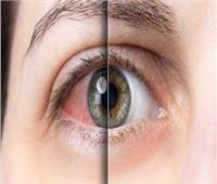 خبراء يحذرون من الكافيين: يجفف العينين ويؤدي إلى فقدان البصر