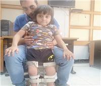 «ماليك» ينتظر طوق النجاة.. طفل حديدي يحتاج عملية نقل أوتار ليقف على قدميه