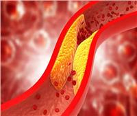 4 أسباب شائعة تشير إلى خطر الإصابة بارتفاع الكوليسترول