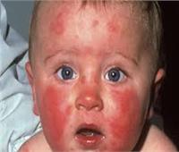 «الشواك الأسود».. مرض خطير يصيب الأطفال تعرف على أعراضه
