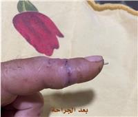 نجاح جراحة إعادة توصيل أصابع مبتورة بمستشفيات جامعة المنوفية