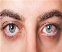 أهم الإسعافات الأولية في حالة إصابة العين