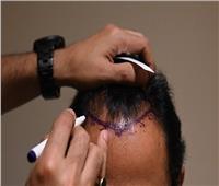 أغرب وفاة بعد عملية زراعة شعر في الهند