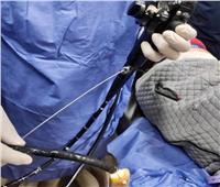  فريق طبي  بمستشفي الطوارئ الجامعي بطنطا ينجح في استخراج «محمول» من معدة شاب| صور