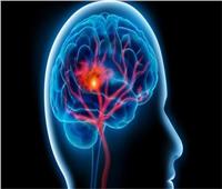فؤاد عودة: التشخيص المبكر للجلطات الدماغية يساعد على خفض عواقب الآثار السلبية