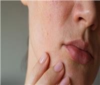 5 مكونات مذهلة يمكن أن تساعد في تهدئة التهاب بشرتك