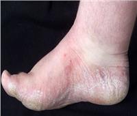 قد يكون مؤشرًا للإصابة بمرض خطير.. أسباب الإصابة بتشقق القدمين