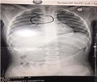 فريق طبي ينجح في استخراج «خرزة» من القفص الصدري لطفلة بمستشفى بنها