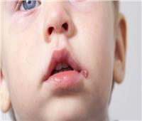 يضرب الأطفال بقوة.. نصائح هامة لعلاج الهربس الفموي