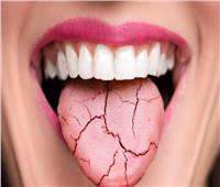 جفاف الفم ينذر بـ5 أمراض خطيرة