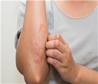 5 علاجات منزلية فعالة تساعد في علاج الطفح الجلدي