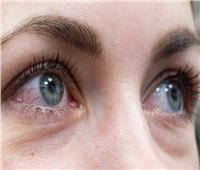 طبيب يوضح سبب التهاب العيون في موسم الربيع
