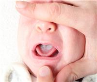للأطفال.. أمراض يصاب بها حديثي الولادة