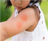 للأمهات..  كيف تحمي طفلك من حساسية الحشرات ومضاعفاتها؟ 