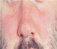 من أعراضه الحكة والجفاف.. ماذا تعرف عن التهاب الجلد وأنواعه؟