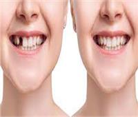 اكتشاف دواء جديد يعيد نمو الأسنان المفقودة