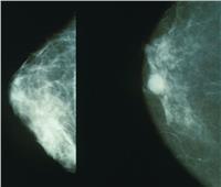 مركب حيوي يوقف انتشار سرطان الثدي في الجسم