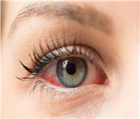 أسباب وأعراض «إنفلونزا العين» وطرق علاجها