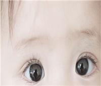 بسبب علاج مضاد لكورونا.. تغير لون عين رضيع من البني للأزرق 