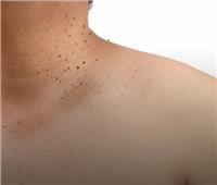 خبراء الأمراض الجلدية يوضحون الطرق الآمنة لعلاج الزوائد الجلدية.. تفاصيل
