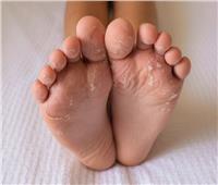 للسيدات| نصائح منزلية للتخلص من الجلد الزائد في القدمين 
