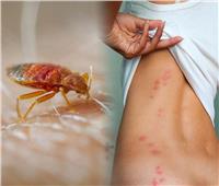 استشاري أمراض جلدية يوجه نصائح للقضاء على حشرة «البق»