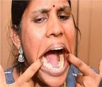 فتاة تدخل موسوعة جينيس بسبب «فرط الأسنان»