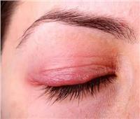 «الكمادات».. أبرز علاج لالتهاب جفن العين