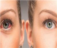 «سارق البصر».. مرض الجلوكوما يهدد 80 مليون شخص