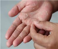 5 أسباب لتقشير جلد اليدين.. منها الغسل المفرط