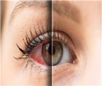 جفاف العين يغير تركيبة الميكربيوم