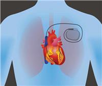 ما هو جهاز تنظيم ضربات القلب.. ومتى يتم استخدامه؟