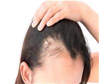الوصفات الطبيعية الفعّالة لتقوية الشعر ومنع تساقطه في مقدمة الرأس