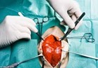 بالفيديو.. إمكانية علاج ثقب القلب جراحياً ونسبة نجاح العملية