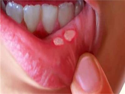 أسباب تؤدي إلى ظهور قرحة الفم