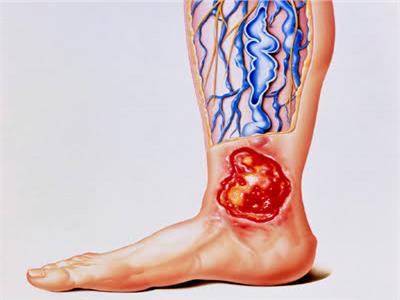 جراحة الأوعية الدموية وعلاج القدم السكري