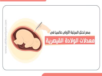 مصر تحتل المرتبة الأولى عالميا في معدلات الولادة القيصرية