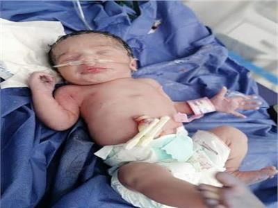 ولادة قيصرية ناجحة لمريضة بمستشفى قها للحجر الصحي
