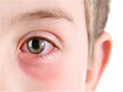 4 علامات تدل على إصابة عينيك بفيروس كورونا.. أبرزها «الحكة» 