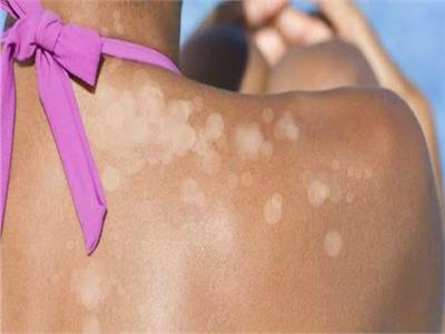 «نصائح مجربة» طرق تقليل الإصابة بالتينيا الملونة في الصيف 